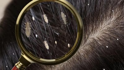 तुमच्याही मुलांच्या केसांत उवा झालेत? समस्या दूर करण्यासाठी करा घरगुती उपाय