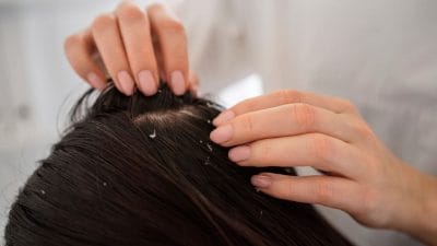 हिवाळ्यात केसांमध्ये प्रचंड कोंडा झालाय? दूर करण्यासाठी करा ‘हे’ घरगुती उपाय