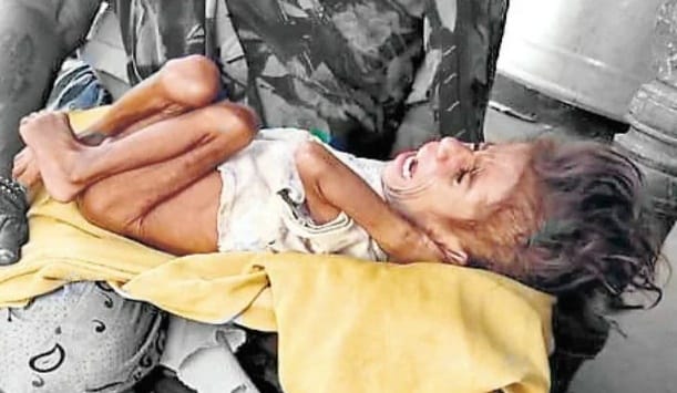 malnourished-four-year-old-child-found-in-state-capital