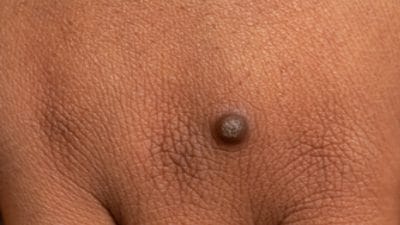 Lifestyle: आखिर क्यूं होते हैं चेहरे और शरीर पर मस्से, जानें इससे जुड़ी पूरी जानकारी