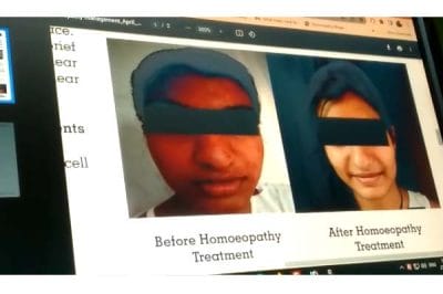 MP News : शरीर से पसीने के बजाय निकल रहा था खून, फिर किया गया ऐसे इलाज कि हुआ चमत्कार।