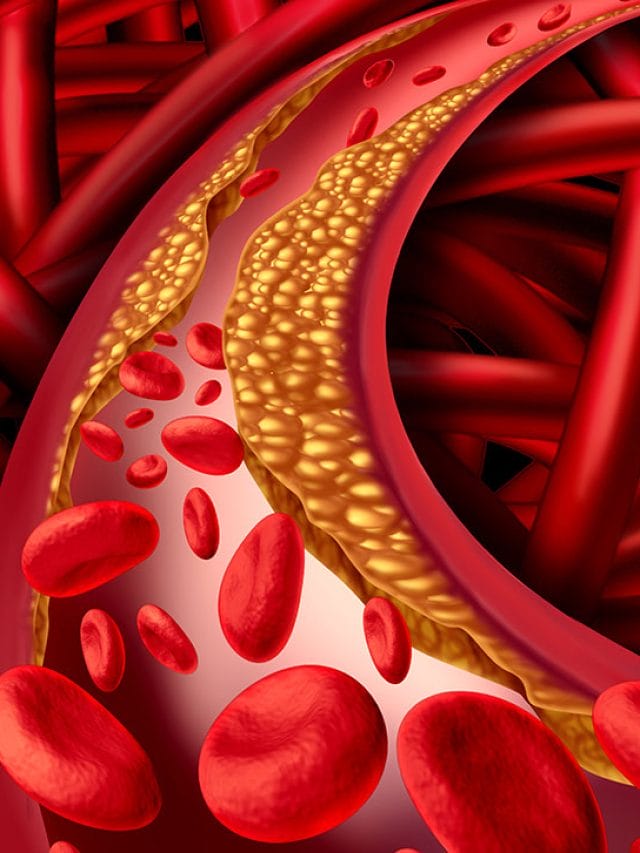 Cholestrol बढ़ने पर पैरों में होते हैं ये बदलाव