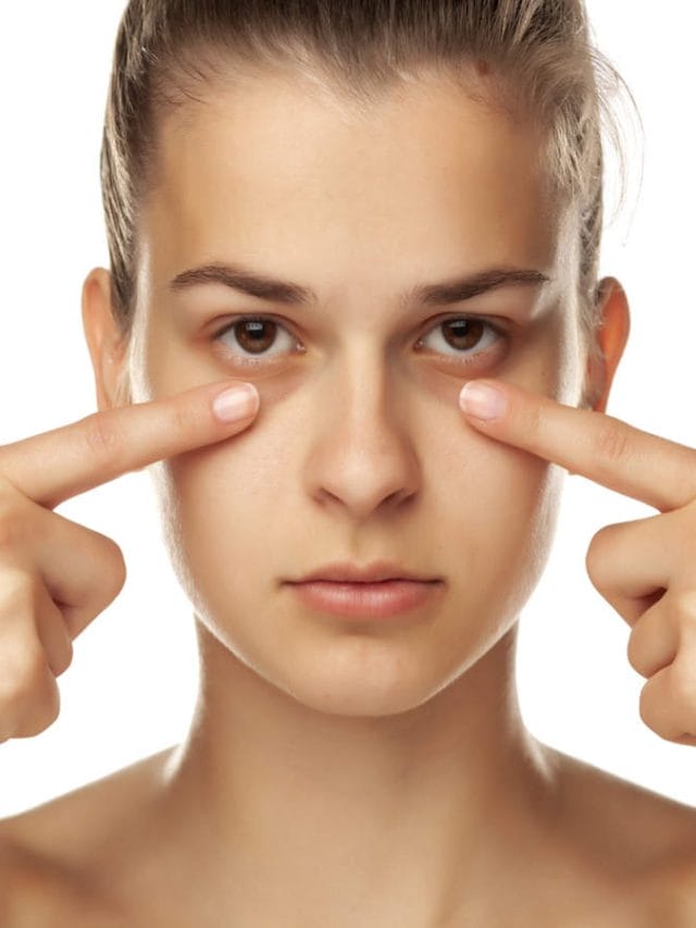 डार्क सर्कल (Dark Circles) से छुटकारा पाने के घरेलू उपाय
