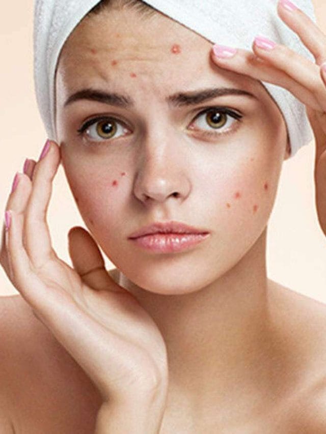 इन फूड्स (Foods) को खाने से हो सकते हैं चेहरे पर Pimples
