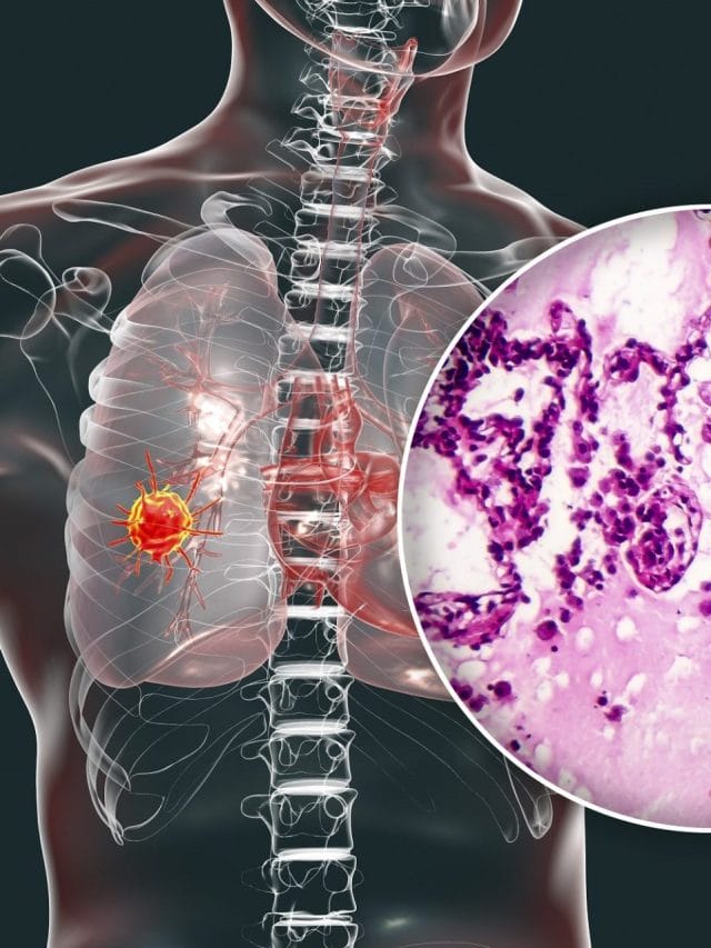 World Lung Cancer Day 2022:  लक्षण, उपचार और रोकथाम