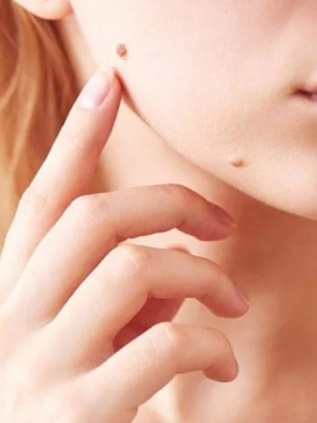 मस्से हटाने के घरेलू नुस्खे