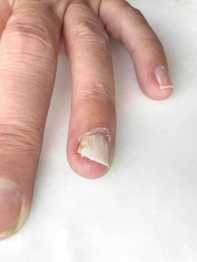 आपके नाखून में ऐसा तो नहीं है, यदि है तो इसके हैं 5 संकेत, सतर्क होने की है जरूरत