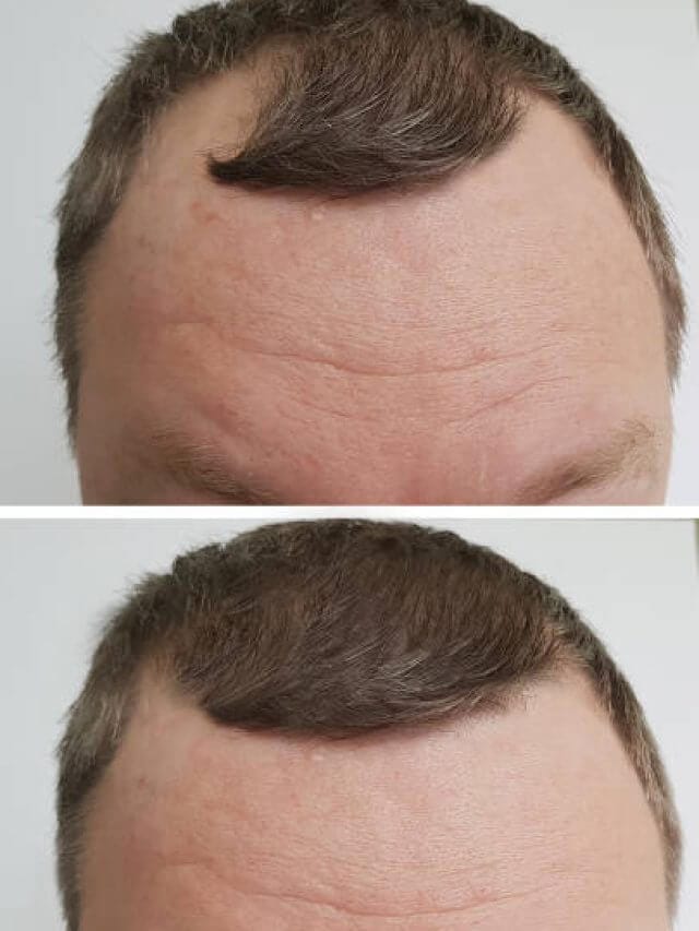 male baldness problem before and after