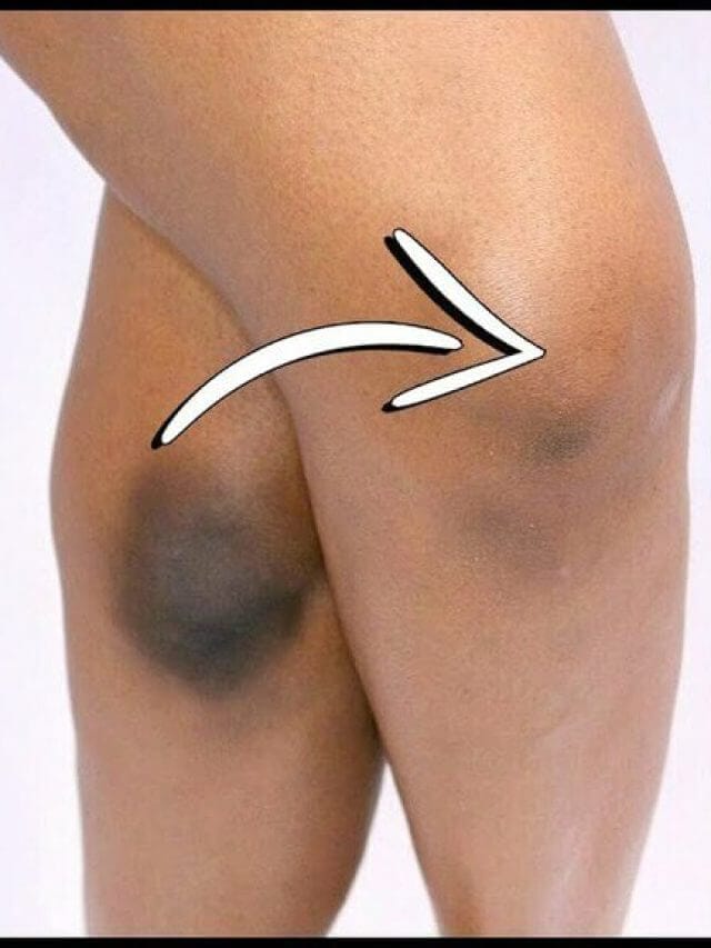 Dark Knee Home Remedies: काले घुटनों से हैं परेशान जानिए 6 असरदार घरेलू नुस्खे जो घुटनों की रंगत को निखारने में मदद करें