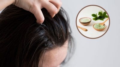 स्कैल्प की खुजली और रैश से छुटकारा चाहिए? अपनाएं नीम और दही का ये देसी नुस्खा