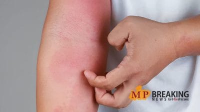 बारिश में स्किन की खुजली से हैं परेशान? ये 5 असरदार घरेलू नुस्खे तुरंत देंगे राहत और ठंडक!