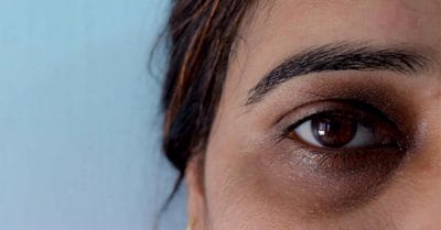 आंखों के नीचे दिखते हैं अलग-अलग रंग के घेरे तो न करें नजरअंदाज, हो सकता है ये संकेत!