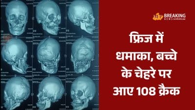 15 साल पुराने फ्रिज में धमाका, 14 वर्षीय लड़के के चेहरे में आए 108 जगह क्रैक, जबलपुर में हुई जटिल सर्जरी